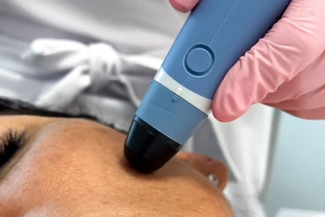 Neinvazivní Termo - Lifting obličeje, krku a podbradku 