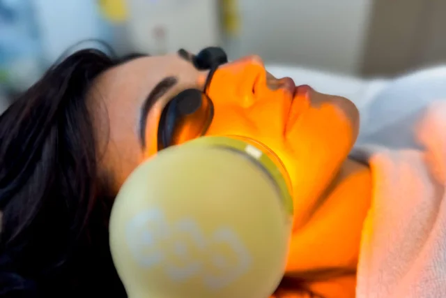 Léčba aktivního akné na obličeji pomocí IPL