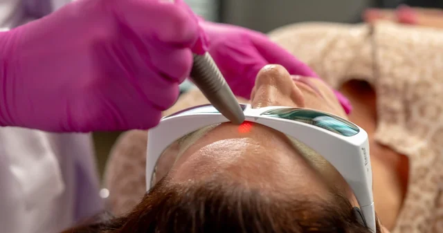 Neinvazivní pozvednutí obočí a omlazení horních víček